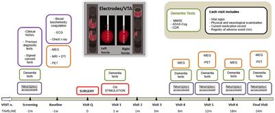 Directional DBS of the Fornix in Alzheimer’s Disease Achieves Long-Term Benefits: A Case Report